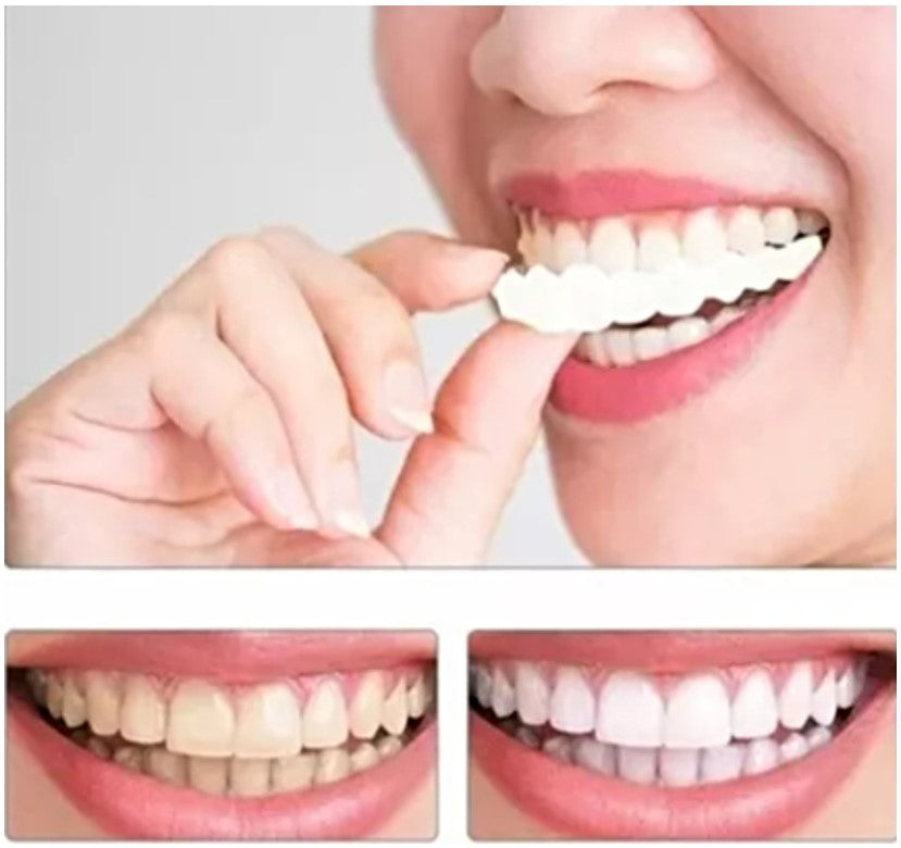 Carillas De Dientes